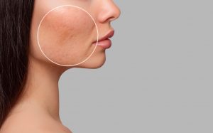 Lee más sobre el artículo Beneficios del láser facial