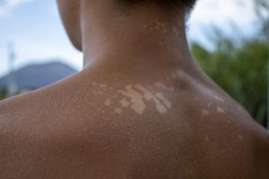 Lee más sobre el artículo ¿Cómo recuperar la piel después del verano?