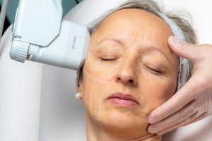 Més informació sobre l'article Tot el que necessites saber sobre HIFU en tractaments d’estètica facial i corporal