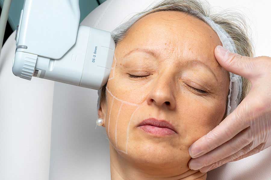 HIFU. Rejuvenecimiento facial y corporal sin cirugía