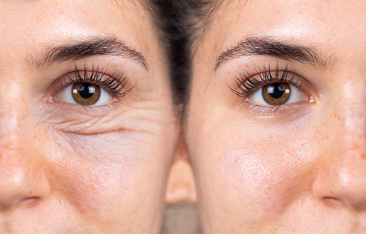 En este momento estás viendo Blefaroplastia: Rejuvenece tu Mirada