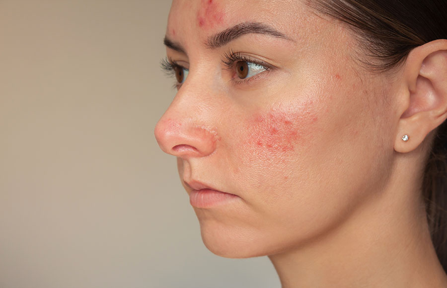 mujer joven con rosacea