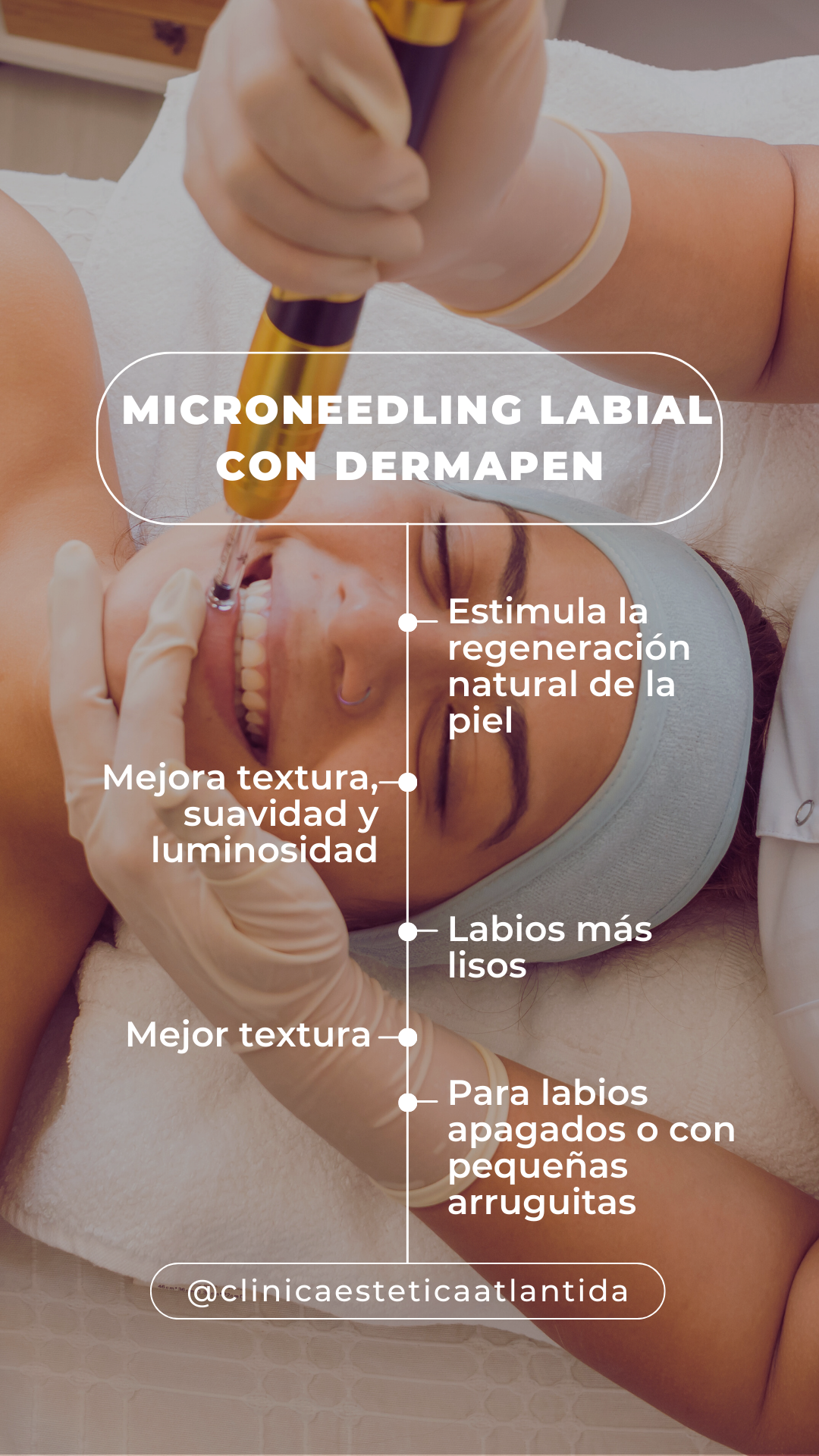 Microneedling labial con Dermapen para regeneración e hidratación de labios.